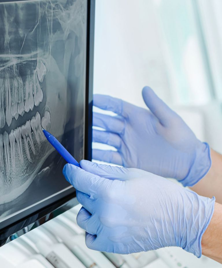 A close-up of a person’s gloved hands pointing at a dental X-ray with a pen 